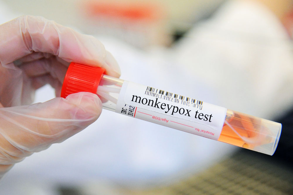 Нужно ли белорусам волноваться из-за оспы обезьян Оспа обезьян